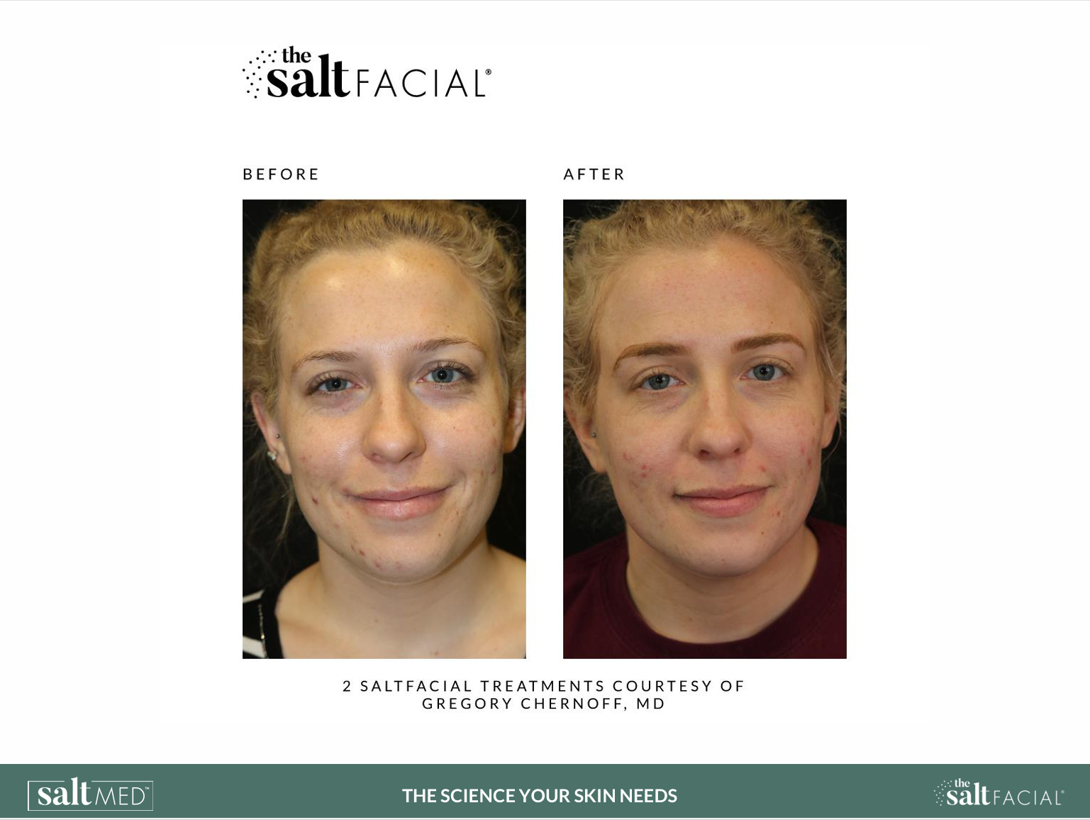 Salt Facial Before & After 2